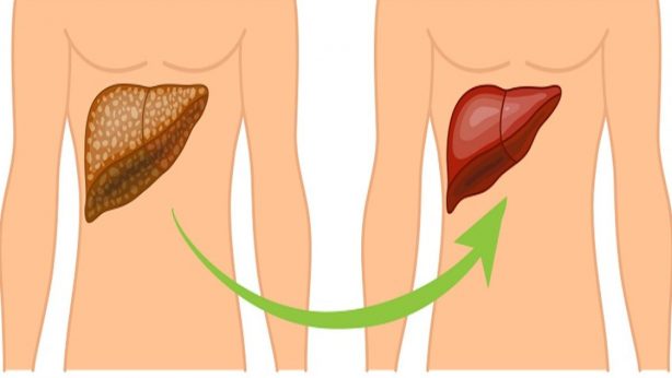 Liver Transplant